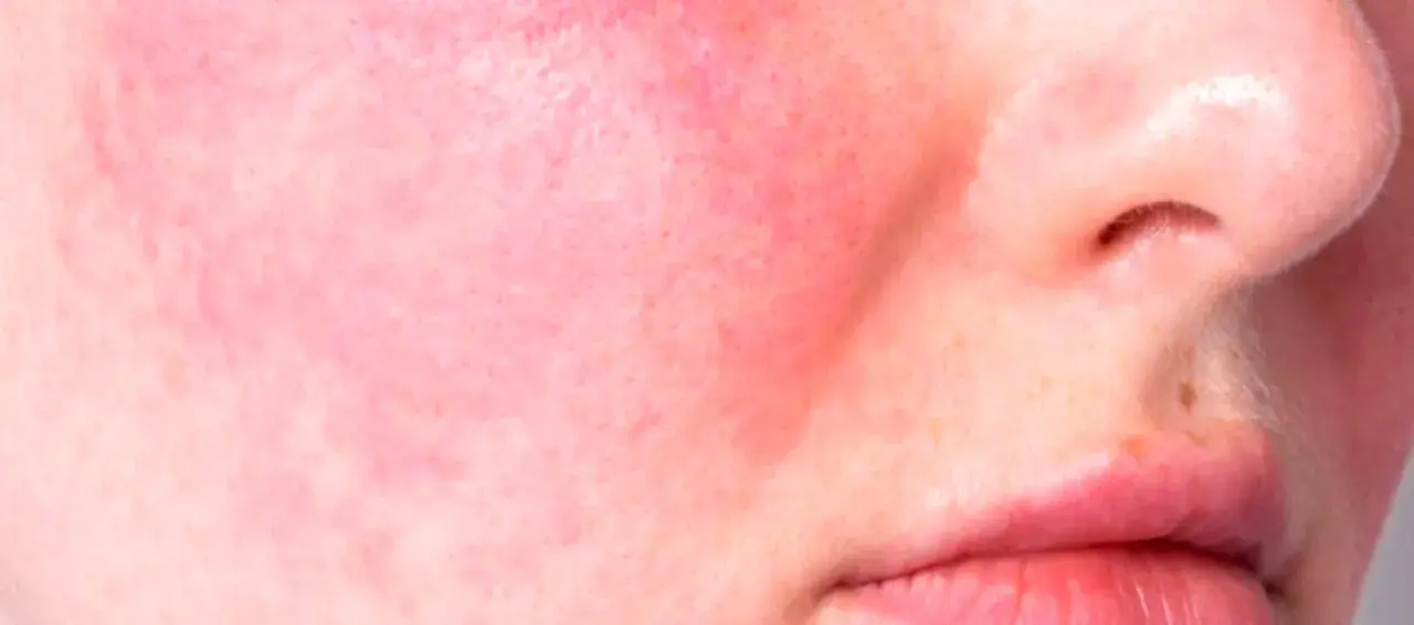 Primo piano di pelle con rosacea, arrossamento diffuso e piccoli vasi sanguigni visibili sulle guance e sul naso.