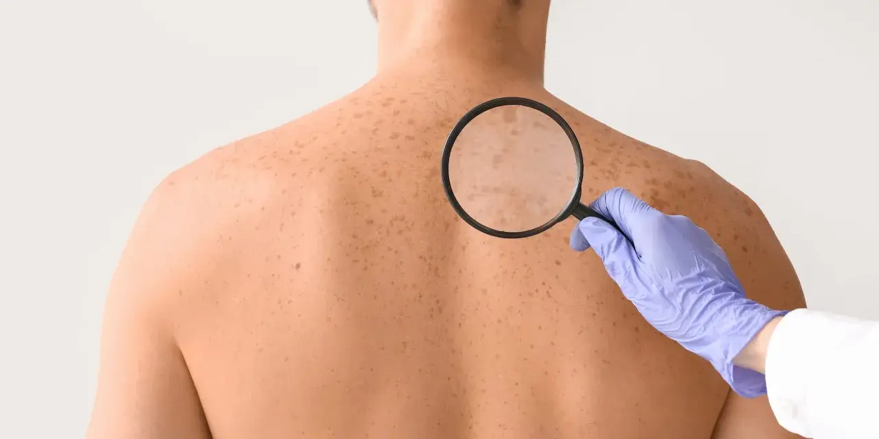 Dermatolog bada plecy pacjenta z licznymi białymi plamami na skórze, używając lupy.