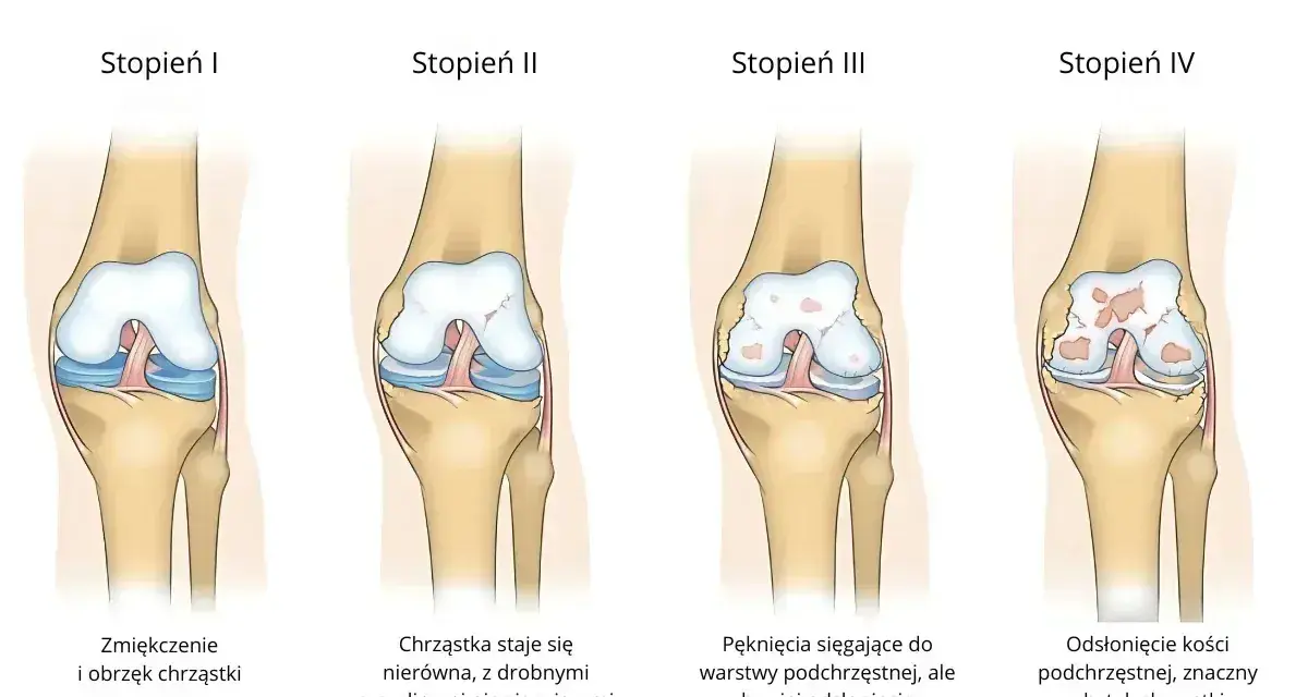 Ilustracja pokazuje cztery stopnie chondromalacji rzepki wg Outerbridge'a: od zmiękczenia chrząstki do odsłonięcia kości.