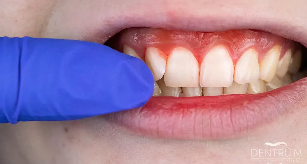 Widoczne są białe zęby i zaczerwienione, krwawiące dziąsła. Niebieska rękawiczka dentystyczna delikatnie odsłania problem.