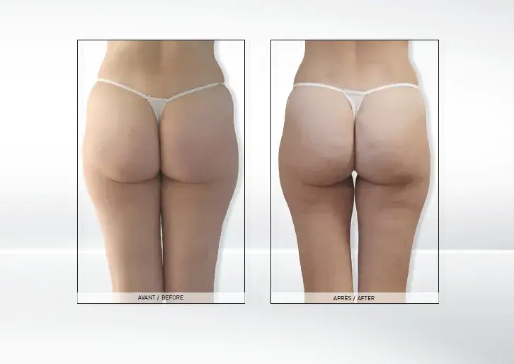 Endermologia: Ile cm stracisz? Realne efekty i wskazówki