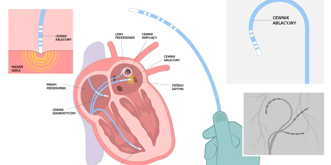 Ilustracja wyjaśnia, co to ablacja migotania przedsionków. Pokazuje cewniki diagnostyczne i ablacyjne w sercu, lokalizujące źródło arytmii.