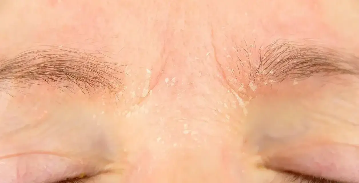 Skóra nad oczami jest zaczerwieniona i łuszczy się, co może być jednym z retinol skutki uboczne.