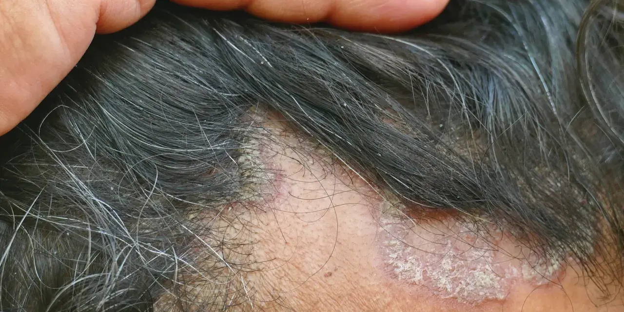 Juckende Kopfhaut mit schuppigen Stellen und Haarausfall. Eine Hand berührt die betroffenen Stellen.