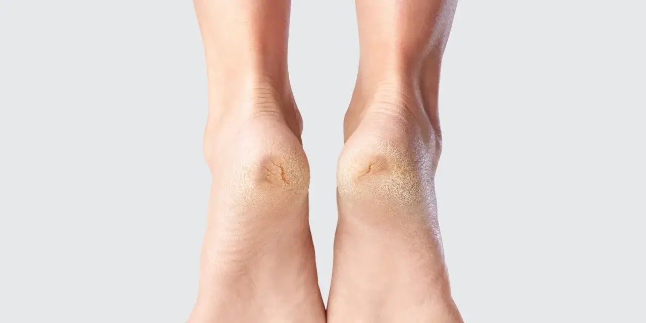 Talons secs et craquelés, un signe qu'il est temps d'envisager un durillon pied traitement naturel pour retrouver douceur et confort.