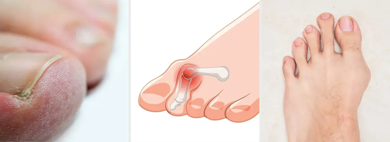 Pie con juanete y uñas afectadas, resultado de usar zapatos estrechos en la parte delantera.