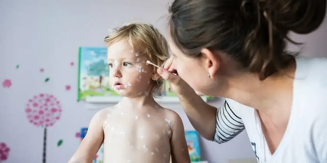 Madre aplica crema a su bebé con miliaria. El niño rubio tiene la piel cubierta de pequeñas erupciones blancas.