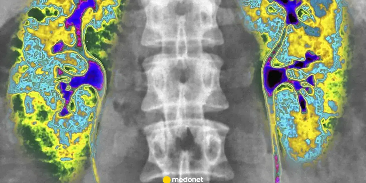 Kolorowa scyntygrafia kości pokazuje nerki i kręgosłup. Obraz uwidacznia obszary o różnej aktywności metabolicznej.