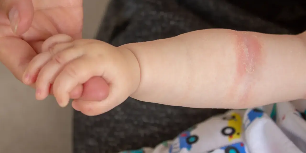 Babyarm mit geröteter Stelle, die auf einen Hautpilz am Po hindeuten könnte.