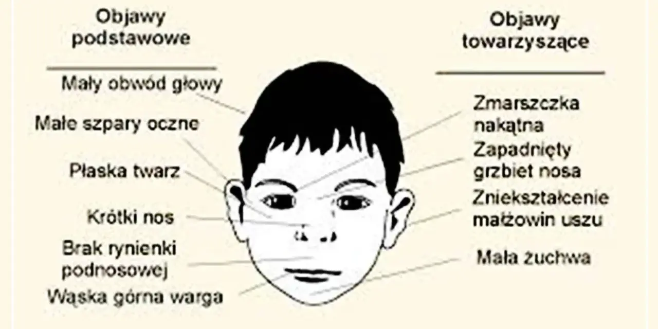Ilustracja twarzy dziecka z zaznaczonymi cechami FAS: mały obwód głowy, płaska twarz, krótki nos, wąska warga.