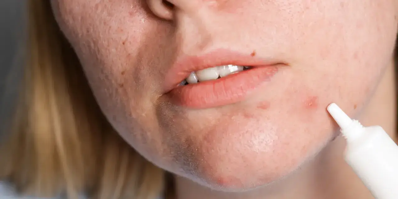 Kobieta aplikuje krem na wyprysk, szukając skutecznych zabiegów na trądzik hormonalny.