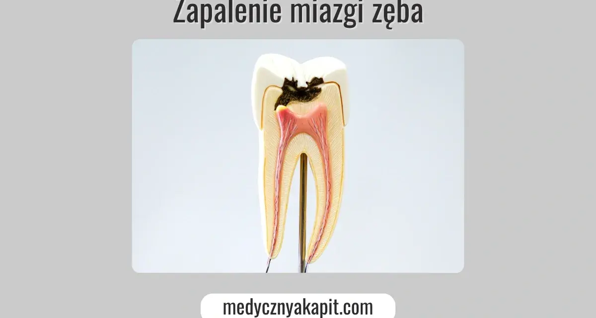 Model zęba ukazujący próchnicę i zapalenie miazgi.