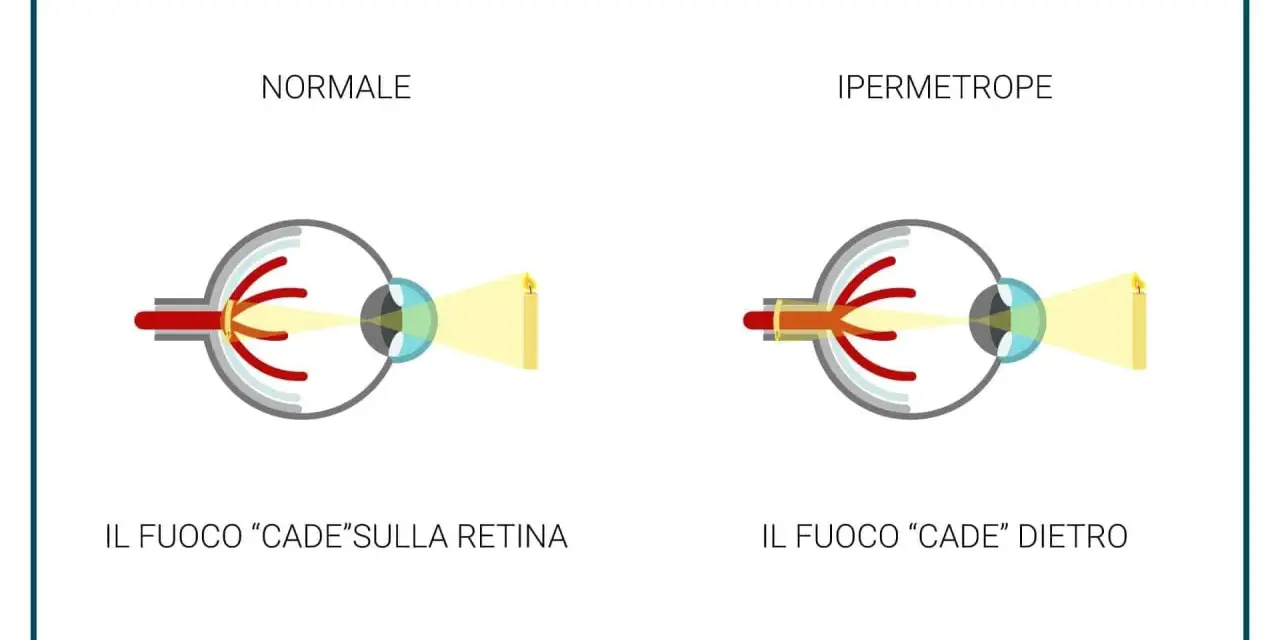 Confronto tra occhio normale e occhio ipermetrope. Nell'ipermetropia lieve, il fuoco cade dietro la retina, rendendo sfocati gli oggetti vicini.