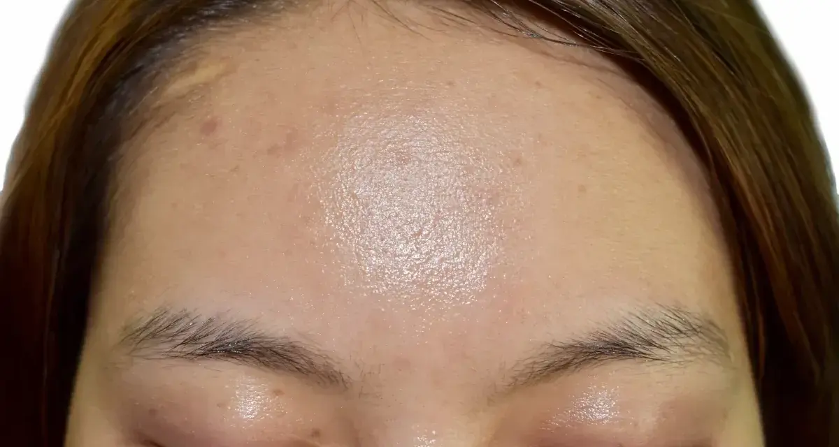 Czoło z widocznym błyszczeniem, oznaki nadmiernego sebum, kilka drobnych niedoskonałości i piegów.