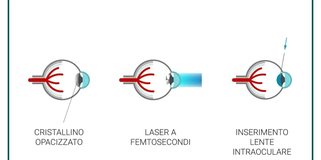 Chirurgia della cataratta con laser: illustra cristallino opacizzato, laser a femtosecondi e inserimento lente intraoculare. Valutare sempre le controindicazioni.