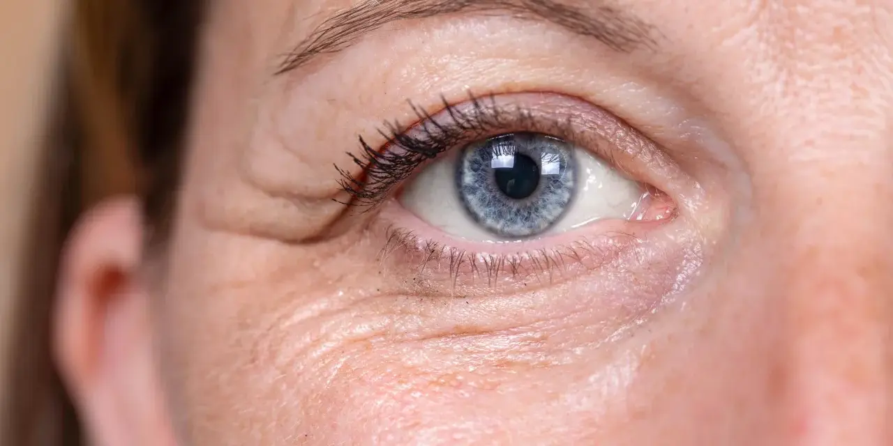 Nahaufnahme eines Auges mit knittriger Haut unter den Augen. Hausmittel können helfen, die Haut zu straffen.