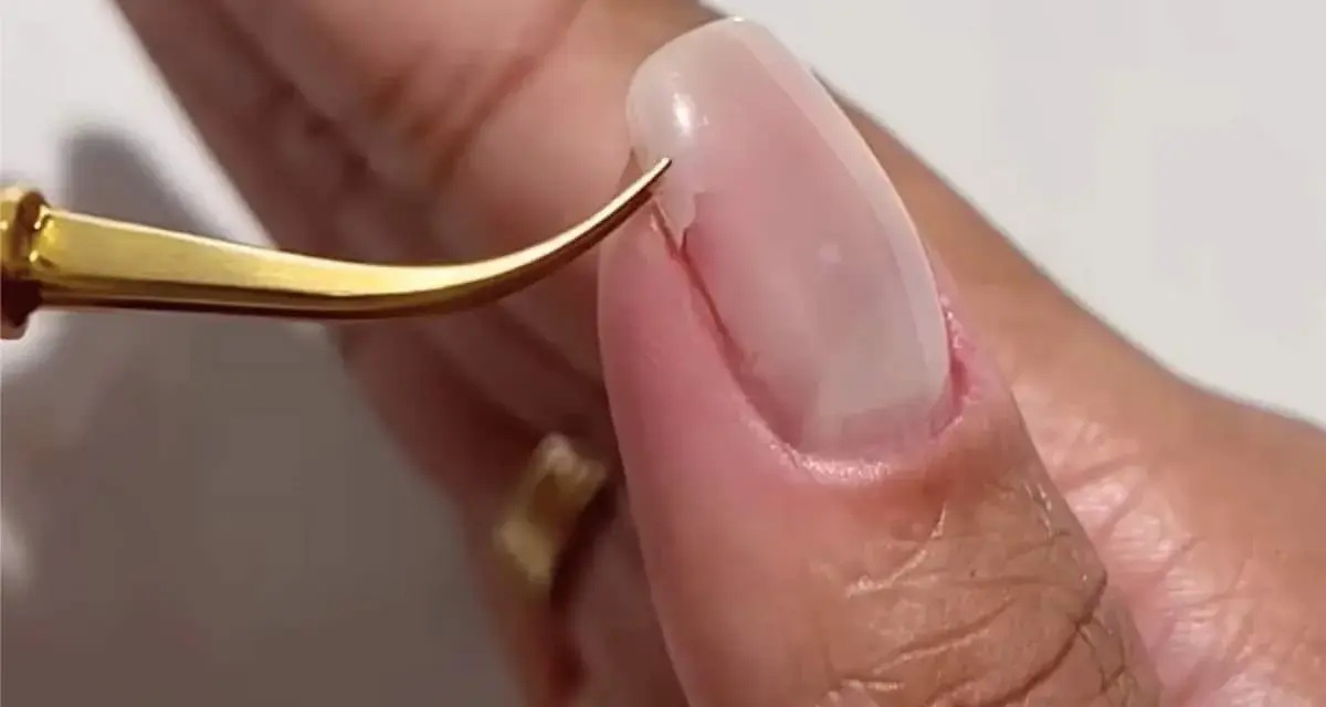 Pince dorée retirant délicatement un ongle arraché, révélant la peau sensible.