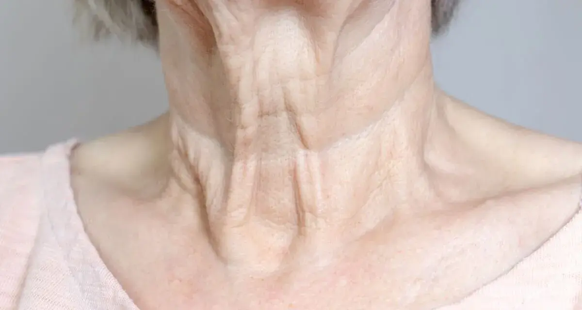 Primer plano del cuello flácido de una mujer mayor, mostrando arrugas y pliegues pronunciados.