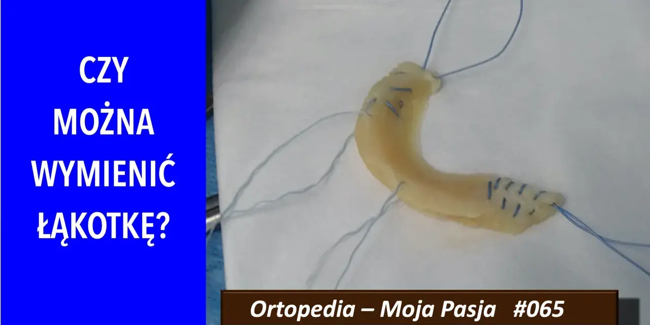 Implant łąkotki NFZ. Czy można wymienić łąkotkę? Ortopedia – Moja Pasja #065.