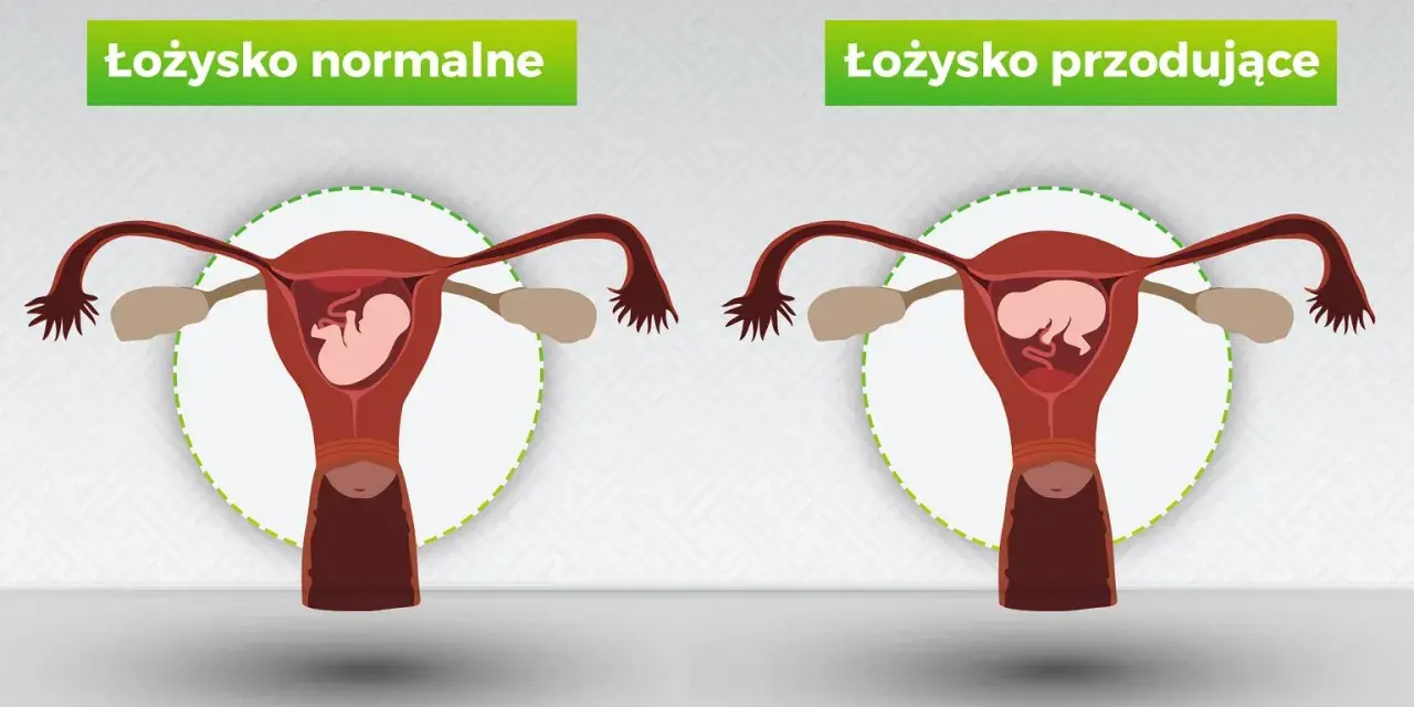 Porównanie: łożysko normalne vs łożysko przodujące. Po prawej stronie widoczna macica z płodem i łożyskiem przodującym, blokującym szyjkę macicy.