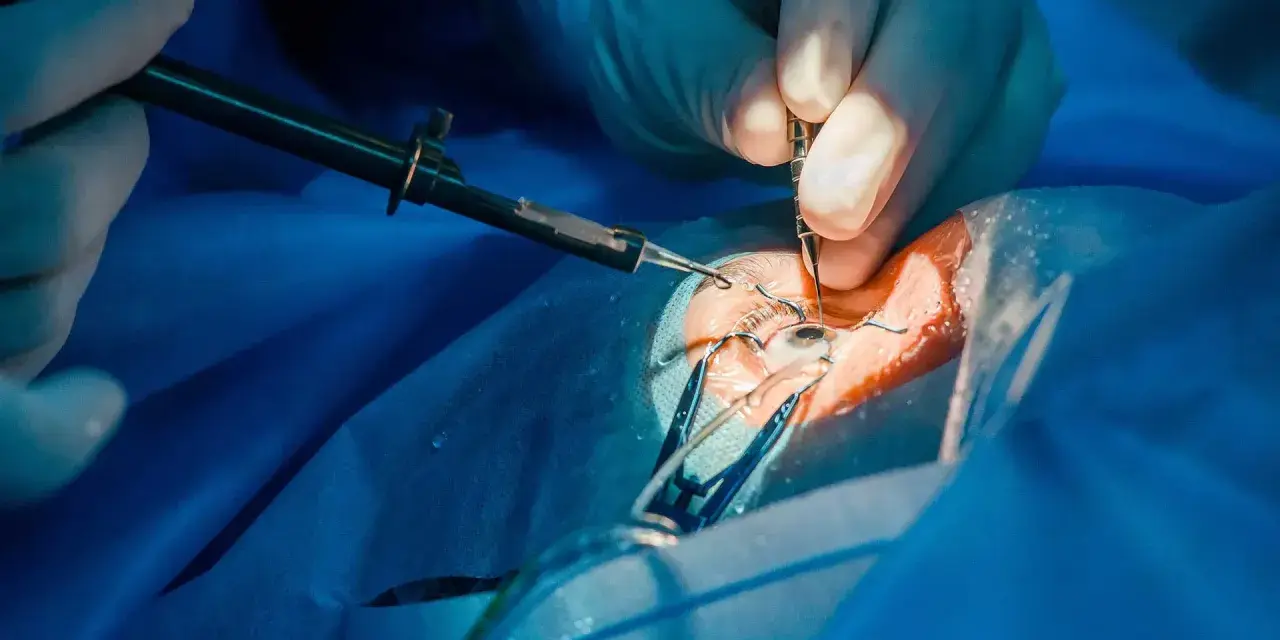 Dettaglio di un intervento glaucoma con tubicino, mani guantate usano strumenti chirurgici sull'occhio.