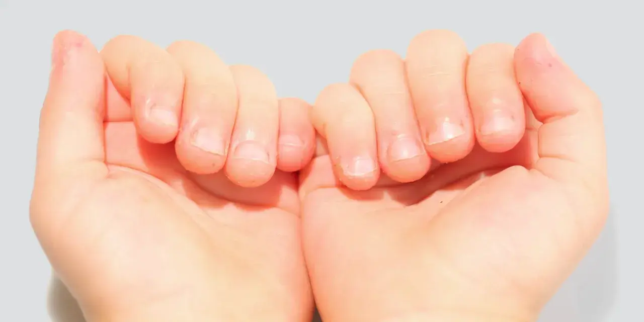 Mains d'enfant montrant des ongles rongés, avec des cuticules irrégulières et des bords d'ongles abîmés.