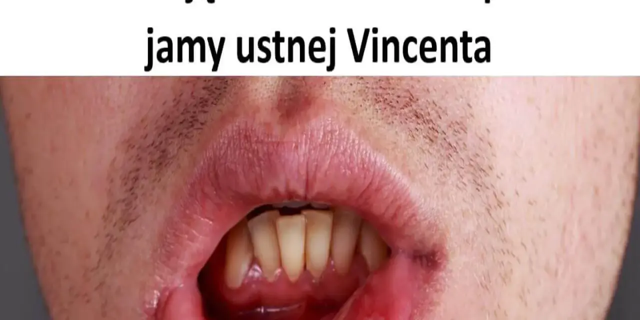 Wrzodziejące zapalenie jamy ustnej Vincenta. Widoczne owrzodzenie na wardze dolnej, wymagające leczenia.