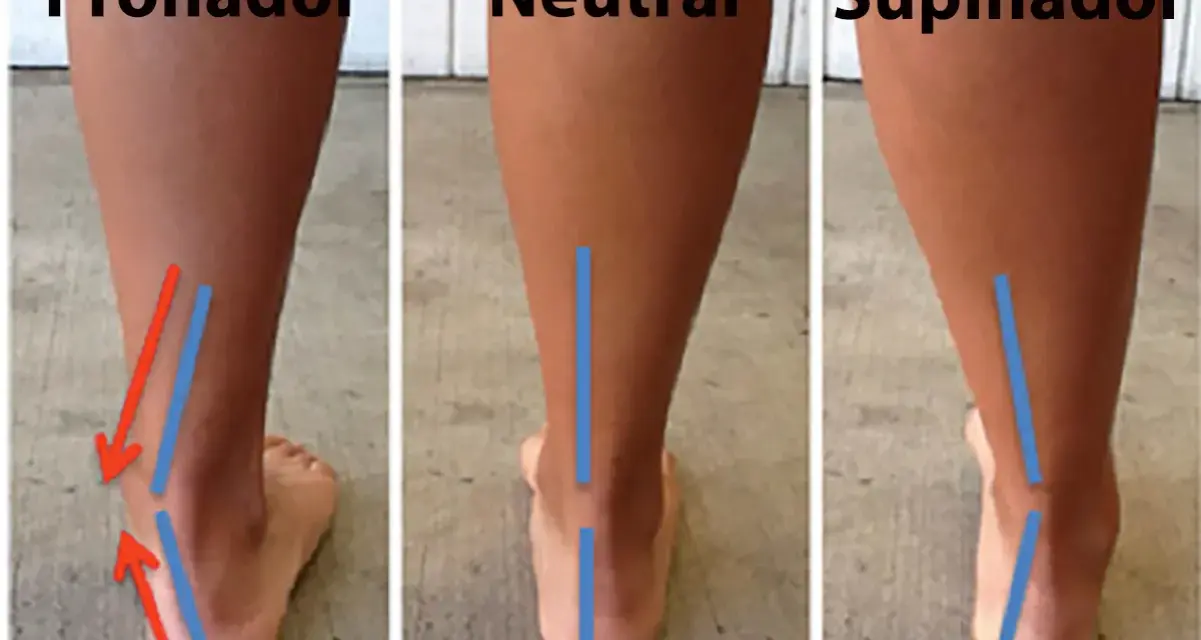 Comparación de pisadas: pronador, neutral y supinador. El desgaste de zapatillas varía según el tipo de pisada.
