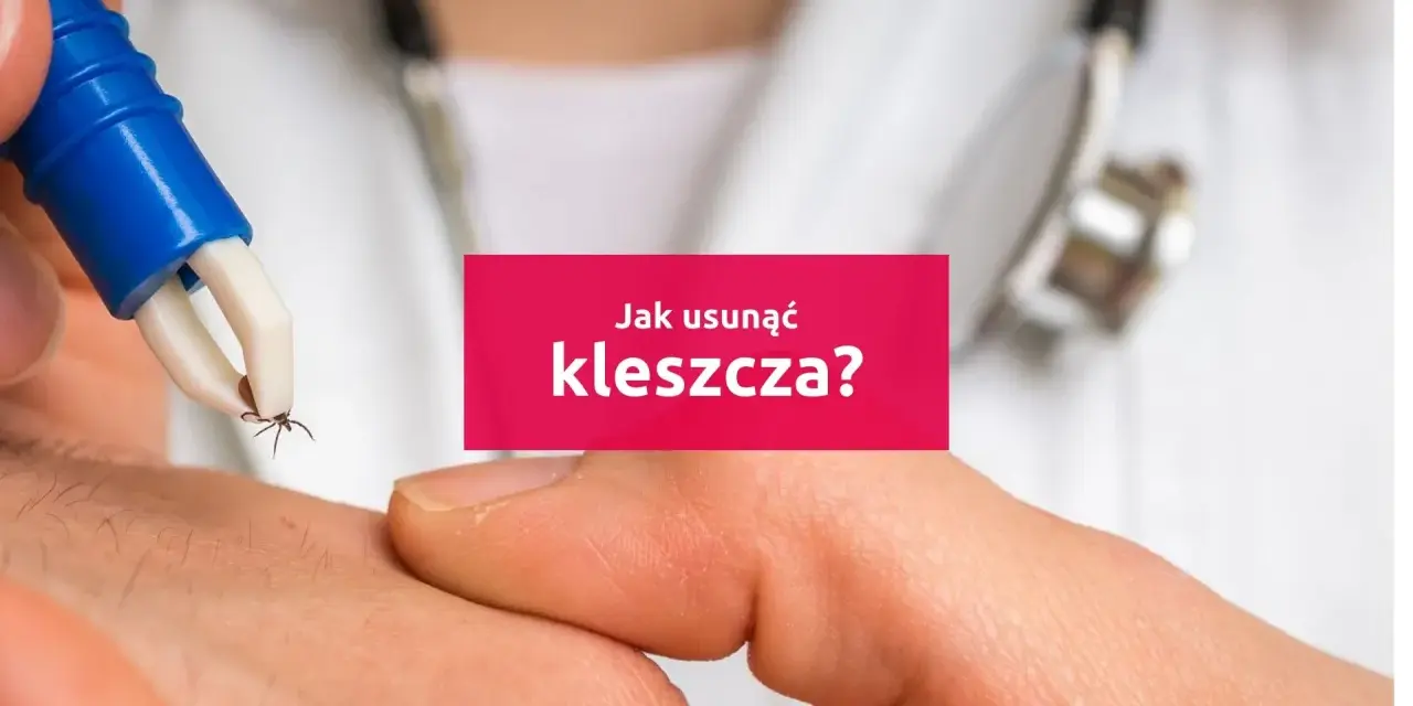 Usuwanie kleszcza pęsetą z ludzkiej skóry.