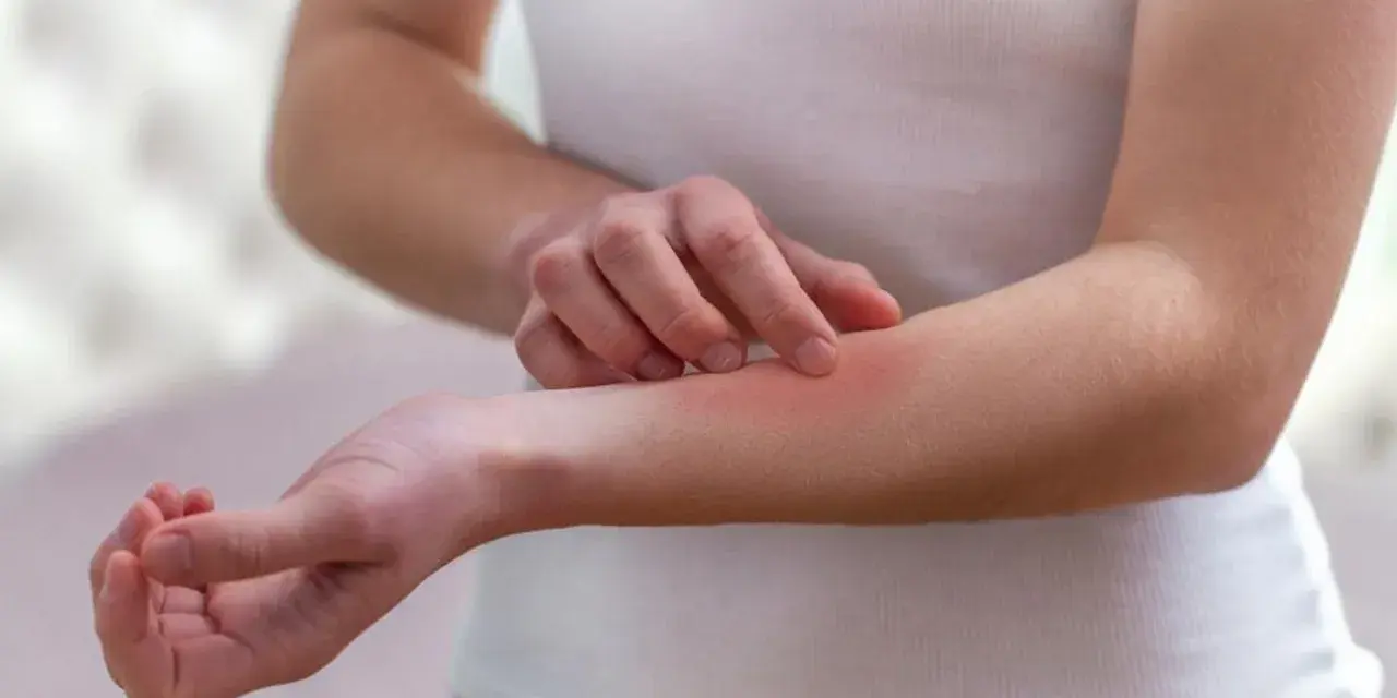 Dłoń drapiąca zaczerwienioną skórę na przedramieniu, objaw mogący wskazywać na lupus.