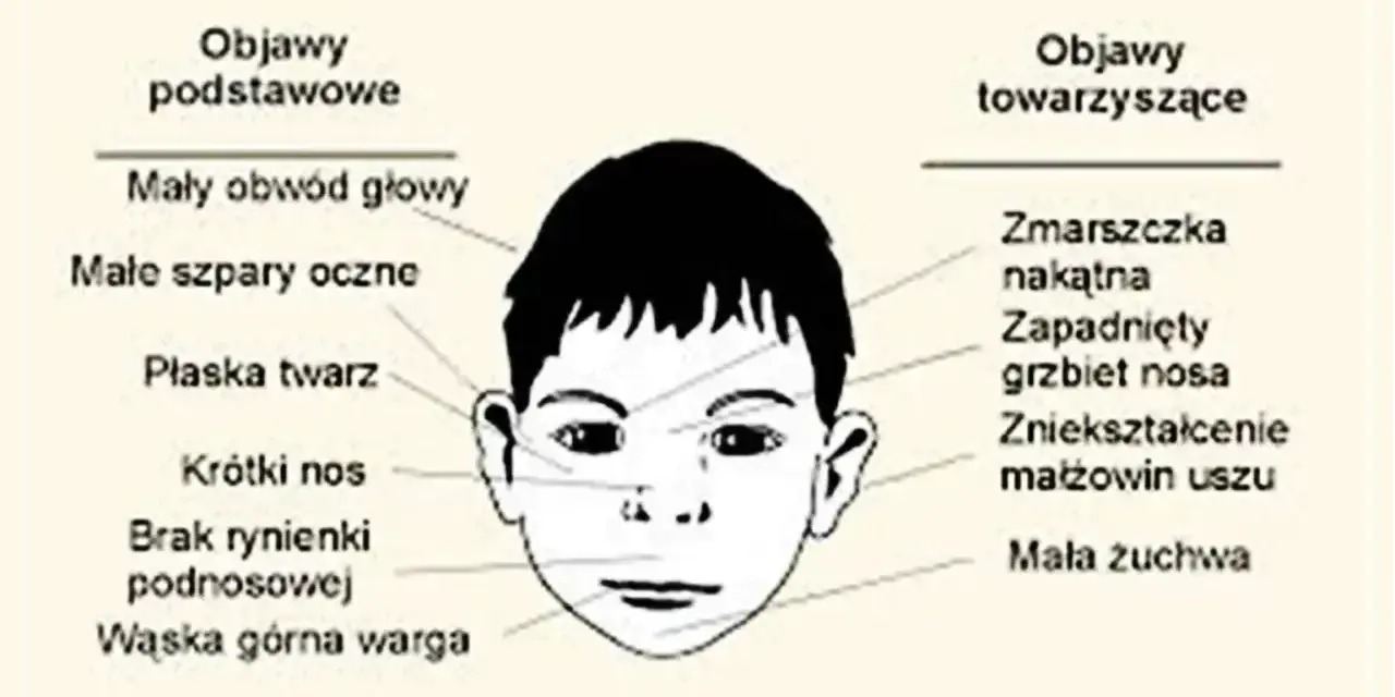 Ilustracja przedstawia twarz dziecka z zaznaczonymi objawami podstawowymi (mały obwód głowy, płaska twarz, krótki nos) i towarzyszącymi (zmarszczka nakątna, zapadnięty grzbiet nosa).