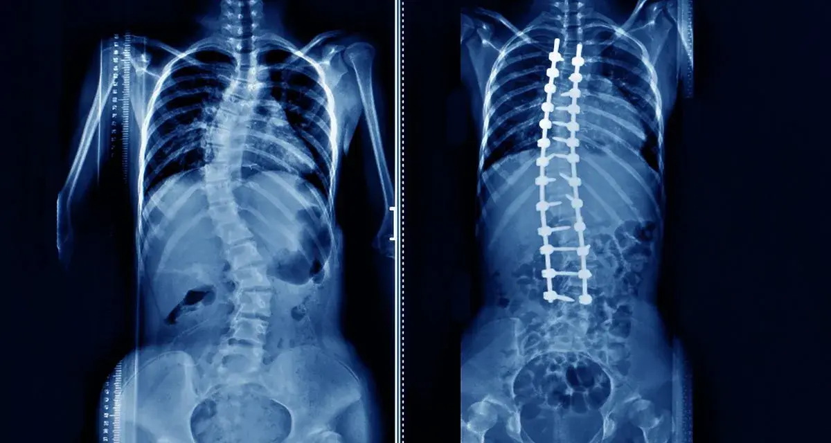 Rentgen klatki piersiowej pokazuje skoliozę kręgosłupa przed i po operacji korekcyjnej z implantami.