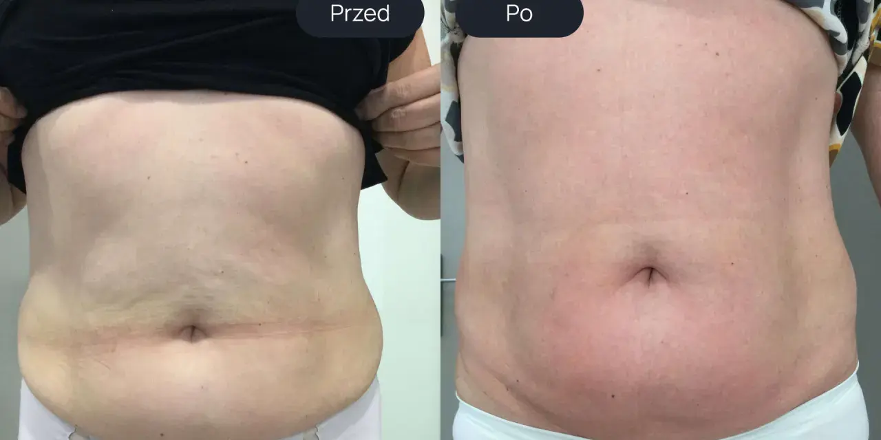 Porównanie brzucha przed i po endermologii. Widoczne wygładzenie skóry i redukcja tkanki tłuszczowej – spektakularne endermologia brzuch efekty.