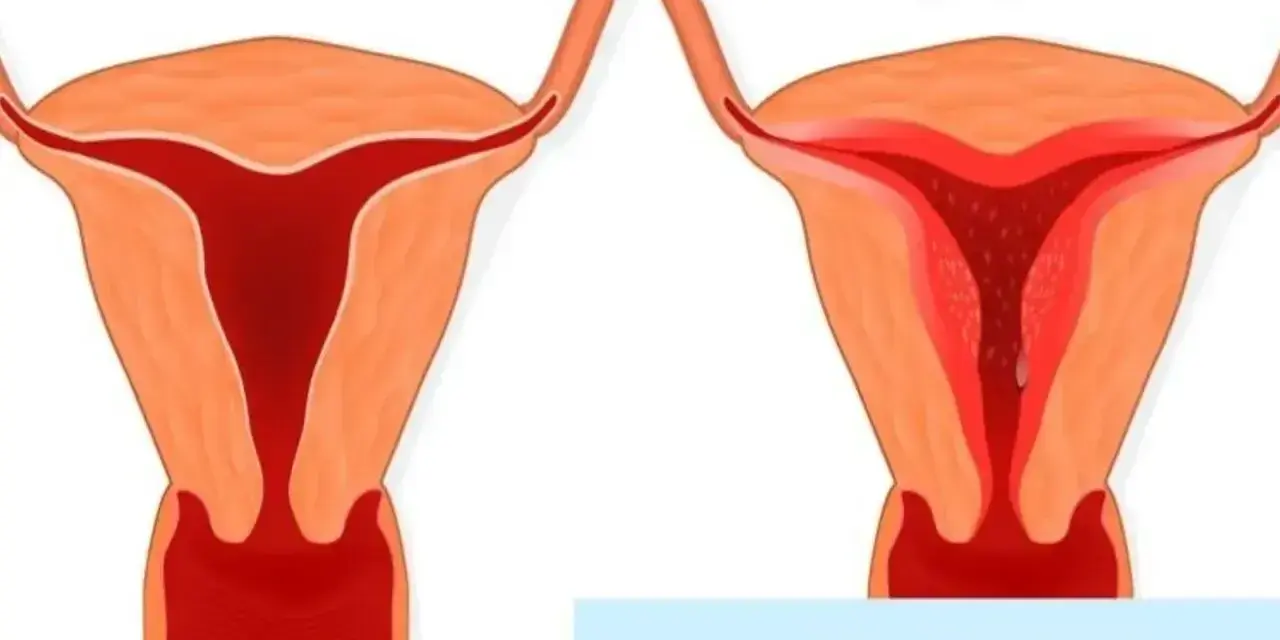 Porównanie prawidłowego endometrium z jego przerostem. Po lewej zdrowa macica, po prawej przerost endometrium.