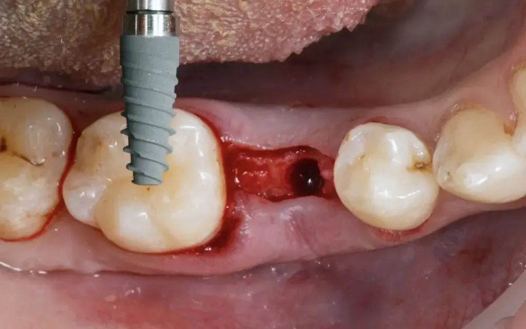 Kiedy implant po wyrwaniu zęba? Poznaj kluczowe terminy i ryzyka
