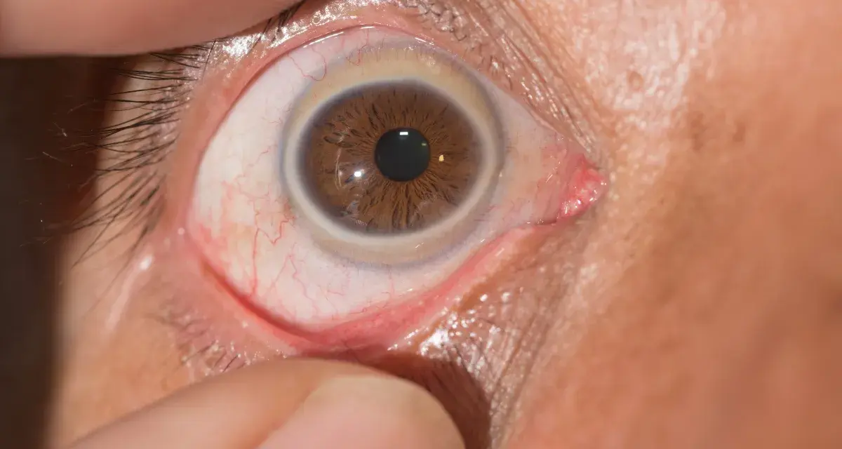 Occhio con iride marrone e un sottile anello di Weiss visibile intorno alla pupilla.