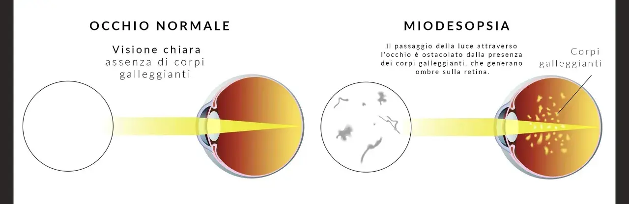 Confronto occhio normale e miodesopsia: corpi galleggianti nel vitreo ostacolano la luce. Ricerca cure naturali per il distacco del vitreo.