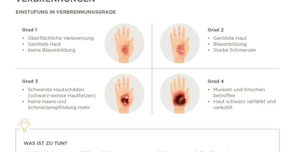 Verbrühungen: Grad 2 zeigt gerötete Haut, Blasenbildung und starke Schmerzen. Ein Arzt sollte ab Grad 2 konsultiert werden.