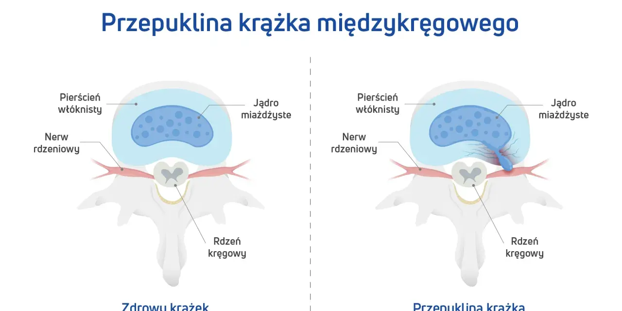 Porównanie zdrowego krążka międzykręgowego z przepukliną krążka szyjnego z uciskiem na worek oponowy.