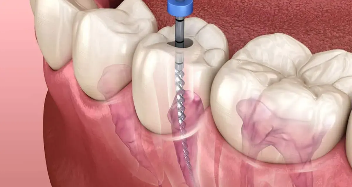 Zabieg kanałowy: wiertło dentystyczne czyści kanał korzeniowy zęba. Czy czwórka ma cztery kanały?
