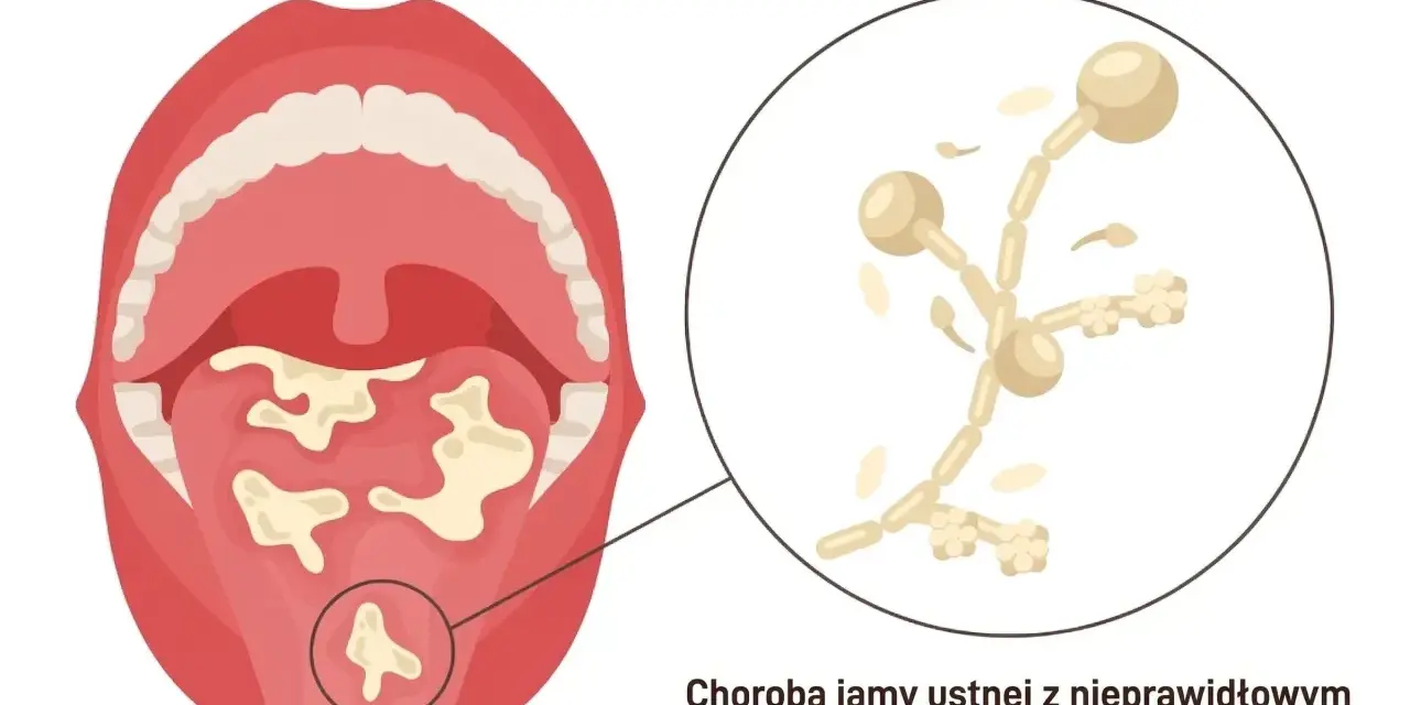 Ilustracja jamy ustnej z nalotem na języku i powiększony obraz grzybów Candida albicans.