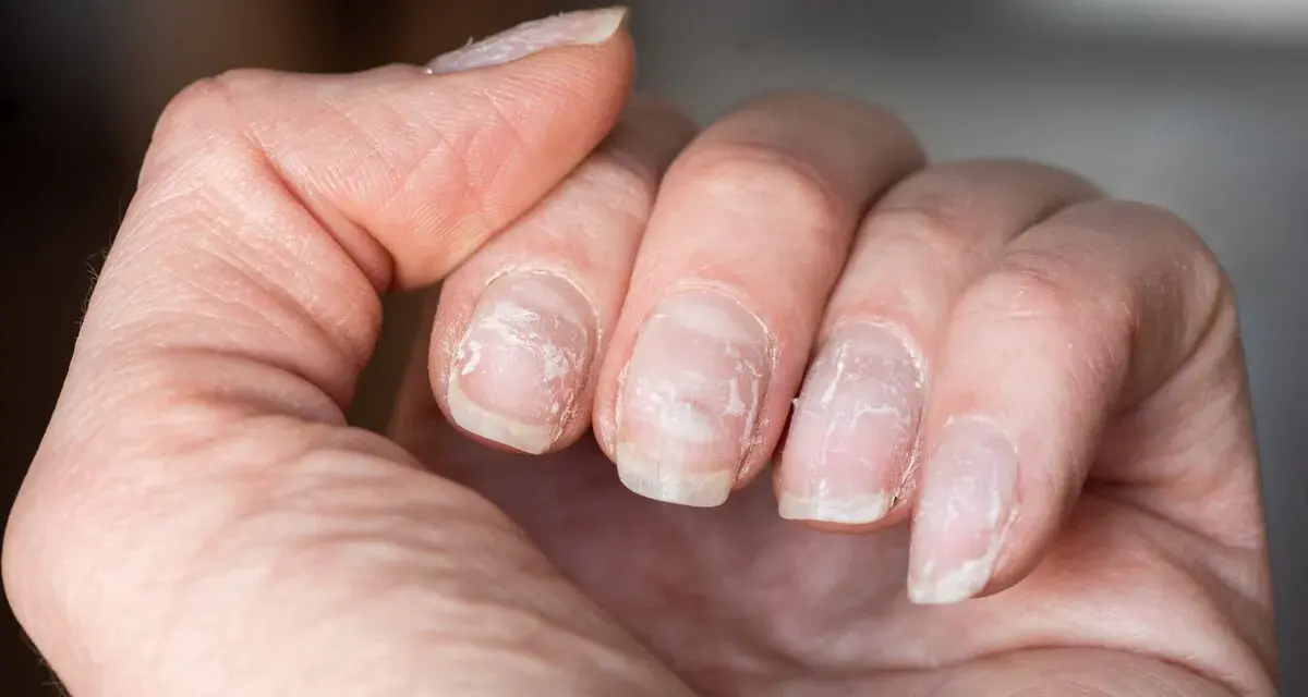 Main abîmée, dédoublée. Pour savoir comment faire pousser ses ongles, il faut hydrater et nourrir.