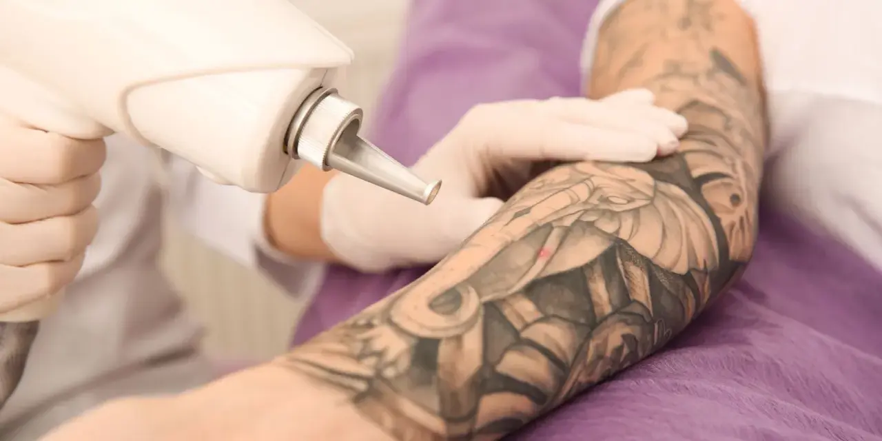 Ręka w rękawiczce trzyma laser do usuwania tatuażu z ręki.