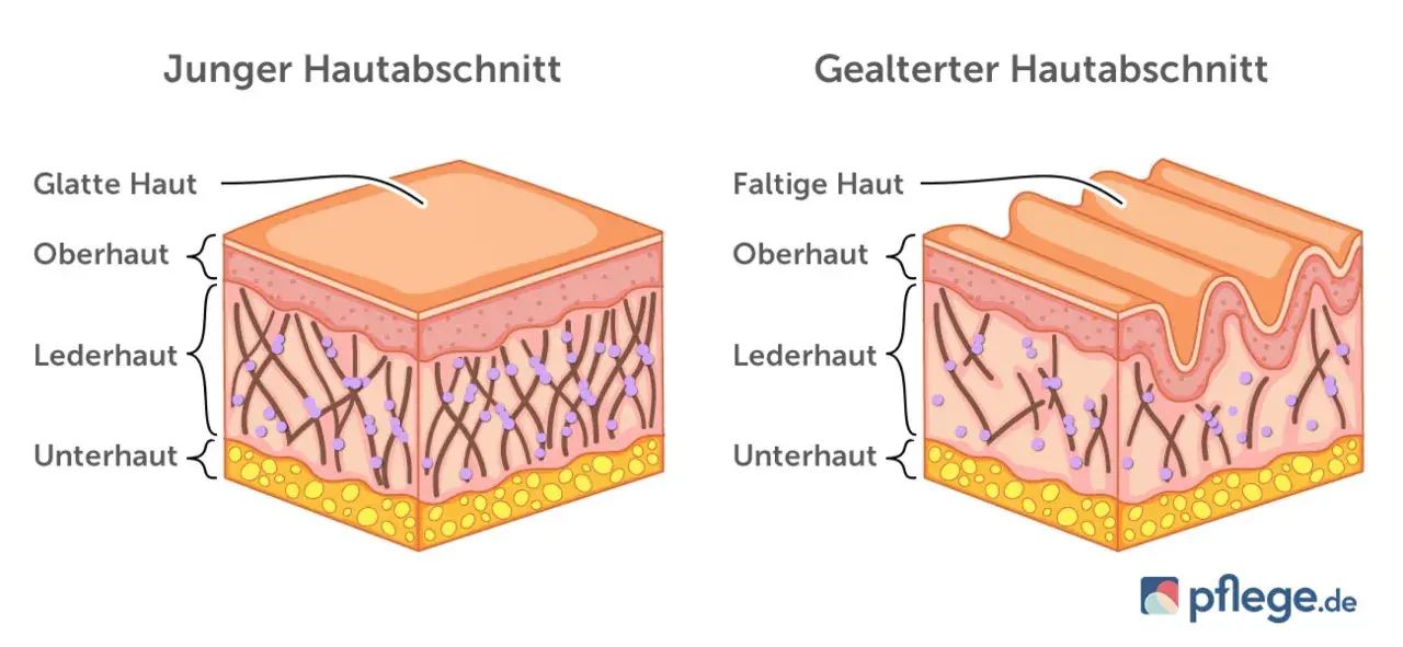 Vergleich von junger, glatter Haut und gealterter, faltiger Haut. Die Lederhaut zeigt bei trockene Haut im Alter weniger Kollagenfasern.