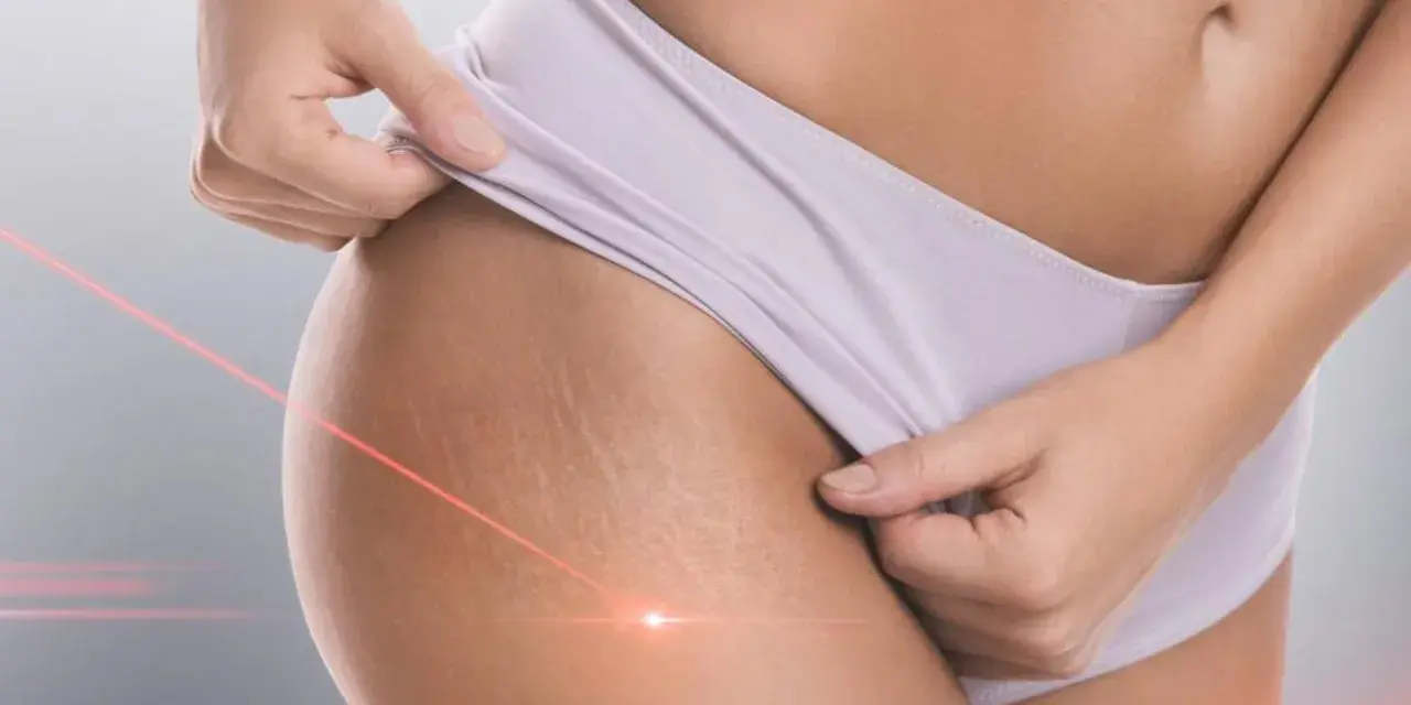 Skóra z widocznymi rozstępami, na którą skierowane są czerwone linie lasera. Zabieg laserowe usuwanie rozstępów.