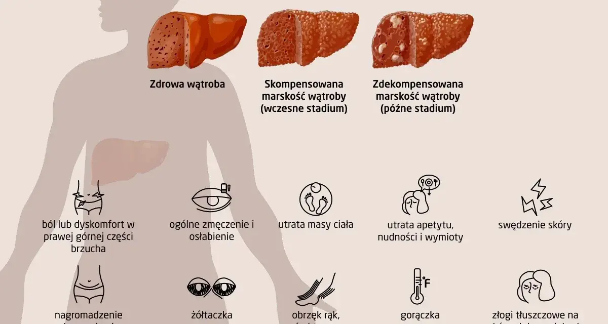 Ilustracja pokazuje zdrowe i chore wątroby, a także objawy marskości wątroby: ból brzucha, zmęczenie, utratę masy ciała, żółtaczkę, obrzęki, gorączkę i zmiany skórne.