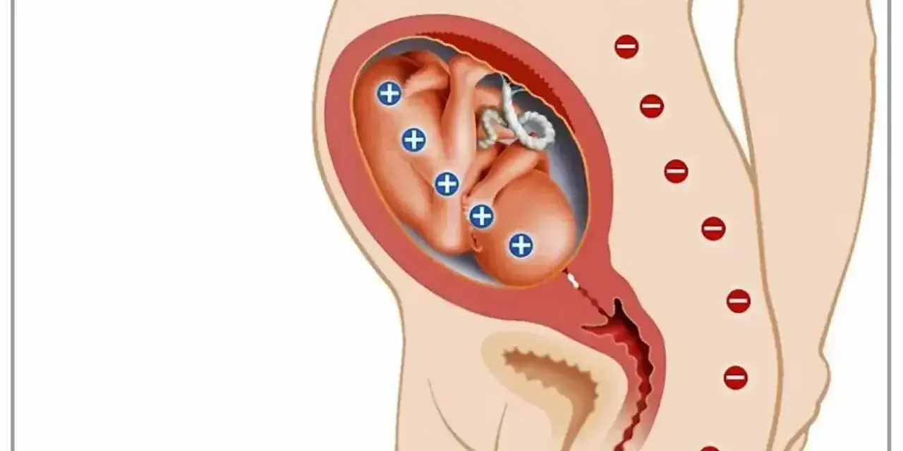 Ilustracja pokazuje płód w macicy z oznaczeniami "+" na ciele, co symbolizuje konflikt serologiczny. Matka ma oznaczenia "-" na kręgosłupie.