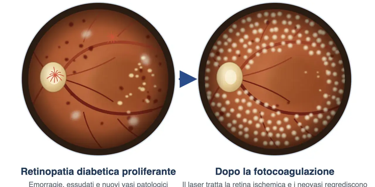 Retinopatia diabetica proliferante con emorragie e essudati, prima e dopo il trattamento laser che riduce la lesione retinica.
