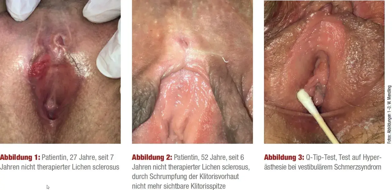 Drei Bilder zeigen die Auswirkungen von Lichen sclerosus: eine entzündete Vulva, eine geschrumpfte Klitoris und einen Q-Tip-Test.