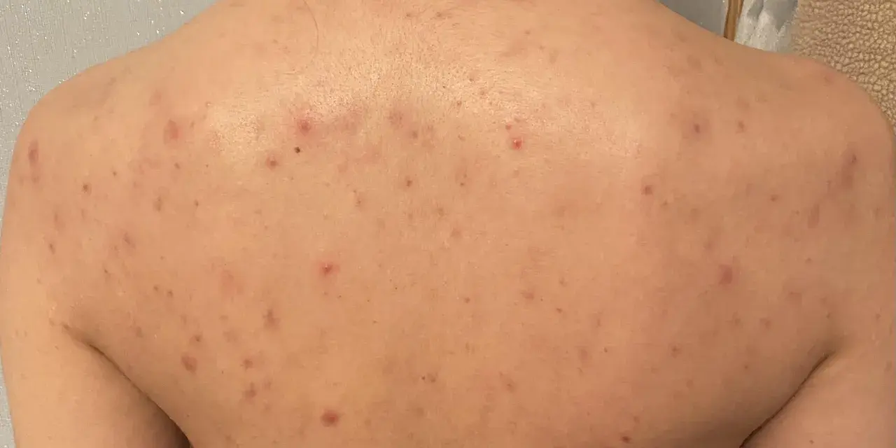 Rygg med utslag av akne på kroppen. Röda prickar och fläckar syns över hela ryggen.